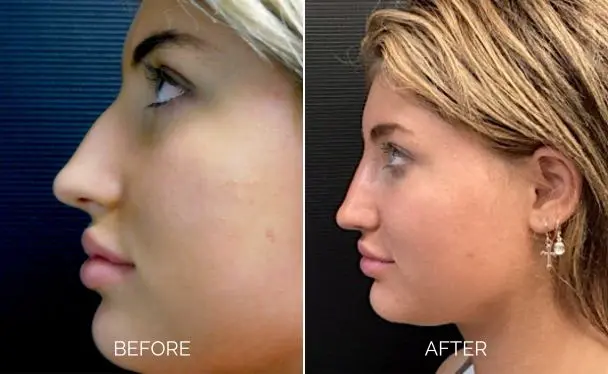 Rhinoplasty before and after left sideview showing an enhanced nose appearance.