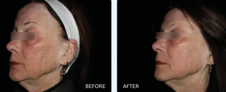 Before and after photos of EMFace treatments in Boulder, CO