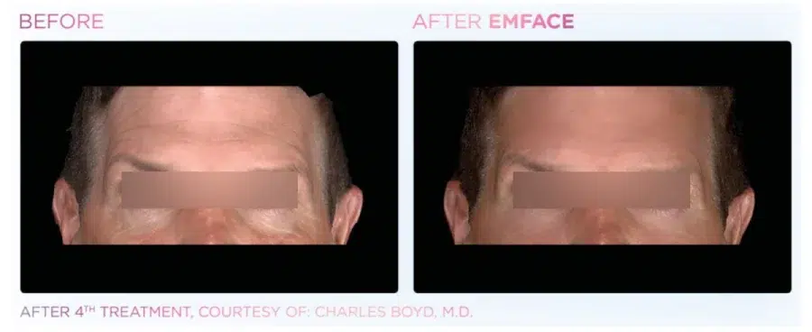 Before and after photos of EMFace treatments in Boulder, CO