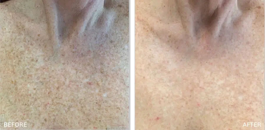 Real treatment results of a Young BBL in Boulder, CO