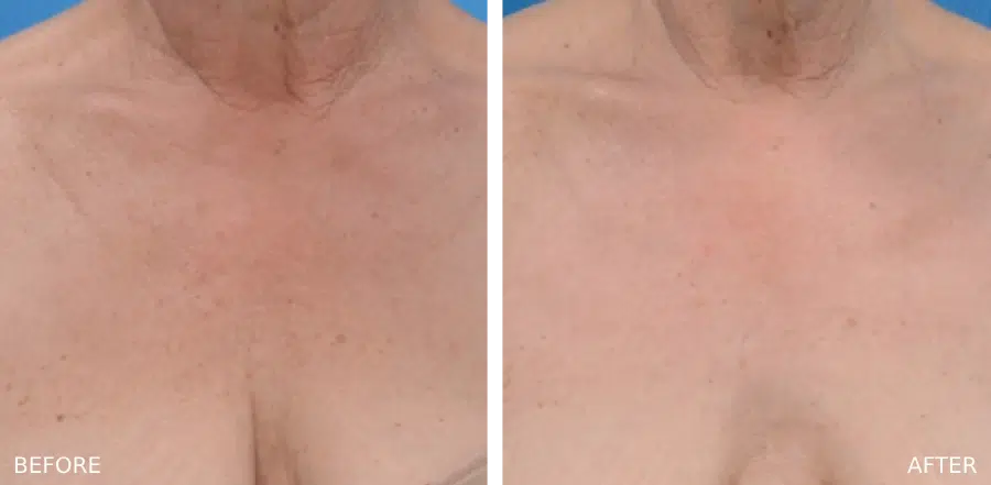 Real treatment results of a Young BBL in Boulder, CO