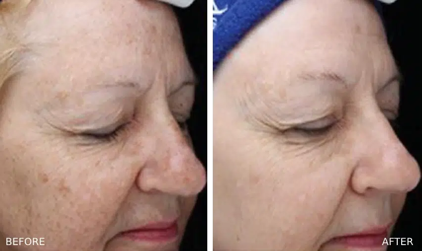 Real treatment results of a Young BBL in Boulder, CO