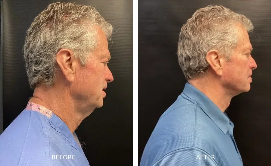 Facelift before and after sideview photos of a male patient showing a reduced sagginess of his skin.