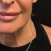 before-and-after transformations at Boulder Valley Laser & Cosmetic 
