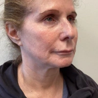 before-and-after transformations at Boulder Valley Laser & Cosmetic 