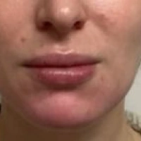 before-and-after transformations at Boulder Valley Laser & Cosmetic 