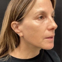 before-and-after transformations at Boulder Valley Laser & Cosmetic 