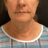 before-and-after transformations at Boulder Valley Laser & Cosmetic 