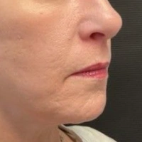 before-and-after transformations at Boulder Valley Laser & Cosmetic 