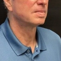before-and-after transformations at Boulder Valley Laser & Cosmetic 