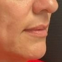 before-and-after transformations at Boulder Valley Laser & Cosmetic 