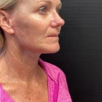 before-and-after transformations at Boulder Valley Laser & Cosmetic 