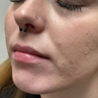 before-and-after transformations at Boulder Valley Laser & Cosmetic 