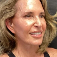 before-and-after transformations at Boulder Valley Laser & Cosmetic 