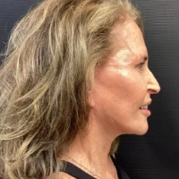 before-and-after transformations at Boulder Valley Laser & Cosmetic 