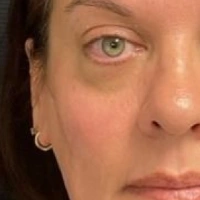before-and-after transformations at Boulder Valley Laser & Cosmetic 