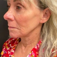 before-and-after transformations at Boulder Valley Laser & Cosmetic 
