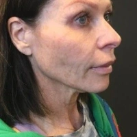 before-and-after transformations at Boulder Valley Laser & Cosmetic 