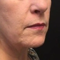 before-and-after transformations at Boulder Valley Laser & Cosmetic 