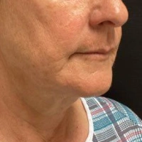 before-and-after transformations at Boulder Valley Laser & Cosmetic 