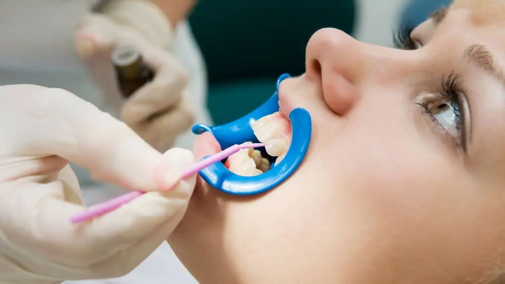 Sealants 3 patient undergoing dental sealant treatment