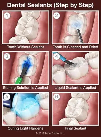 Sealants 2 237946