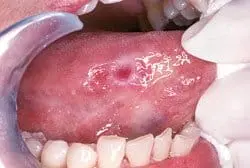 Oral cancer screenings2