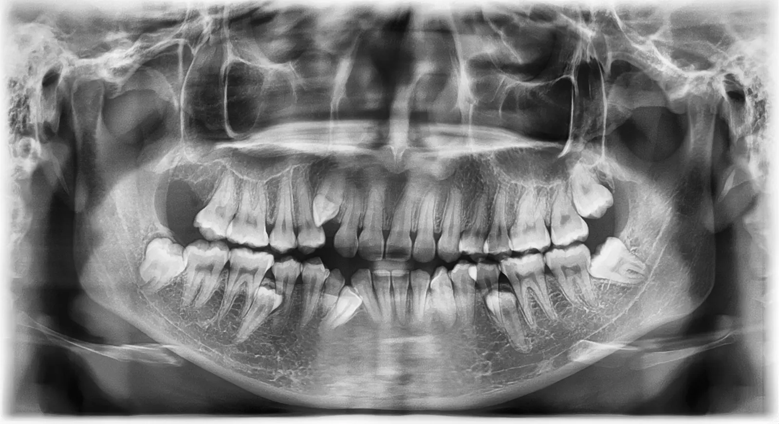 impacted teeth
