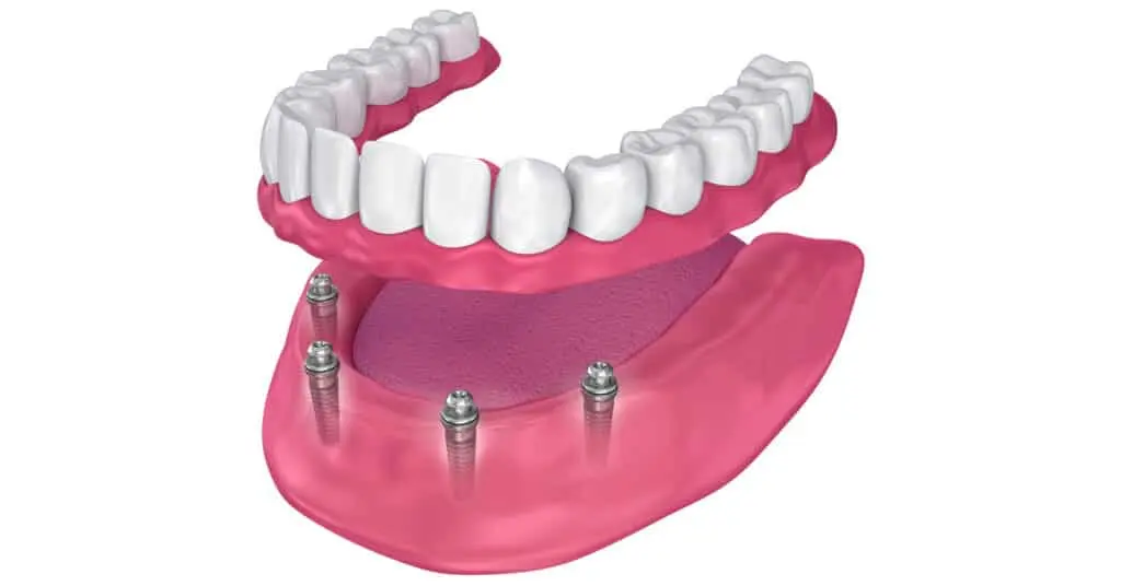 implant dentures1