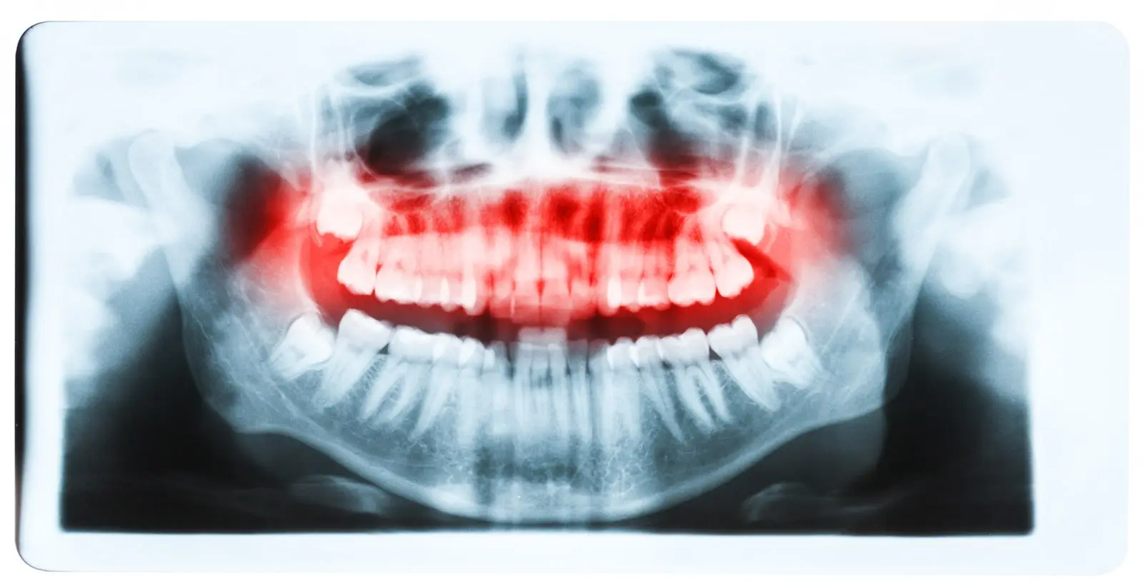 xray impacted