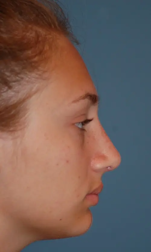 Open rhinoplasty-after