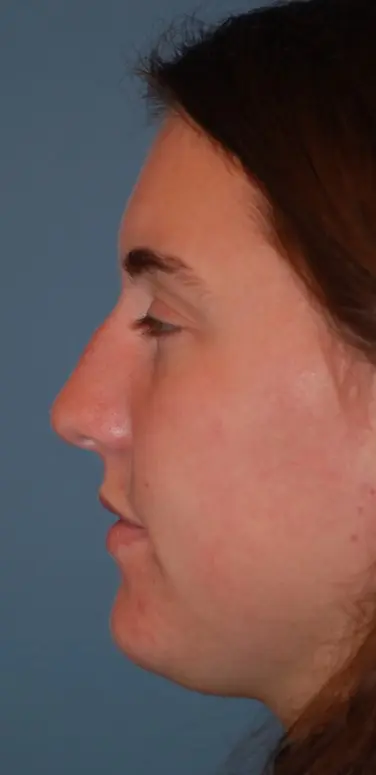 Open rhinoplasty before