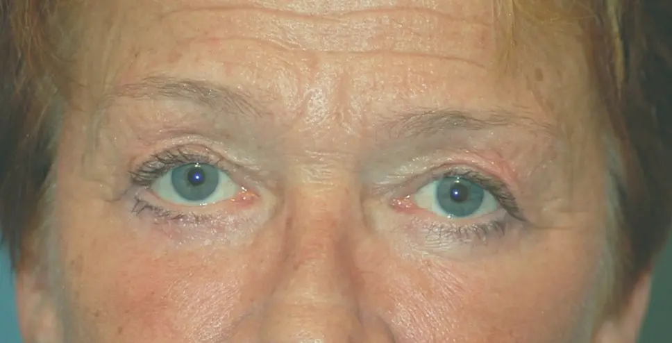 Upper lower eyelids and laser after
