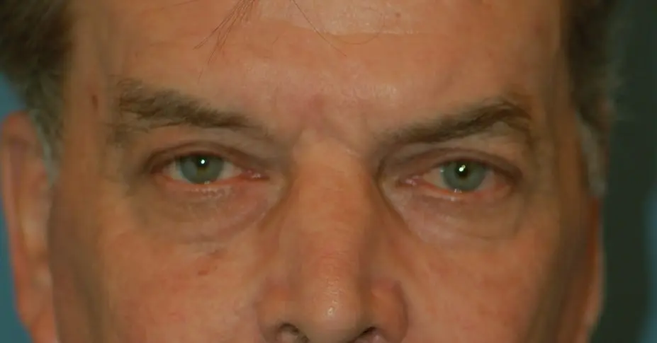 Upper eyelids-after