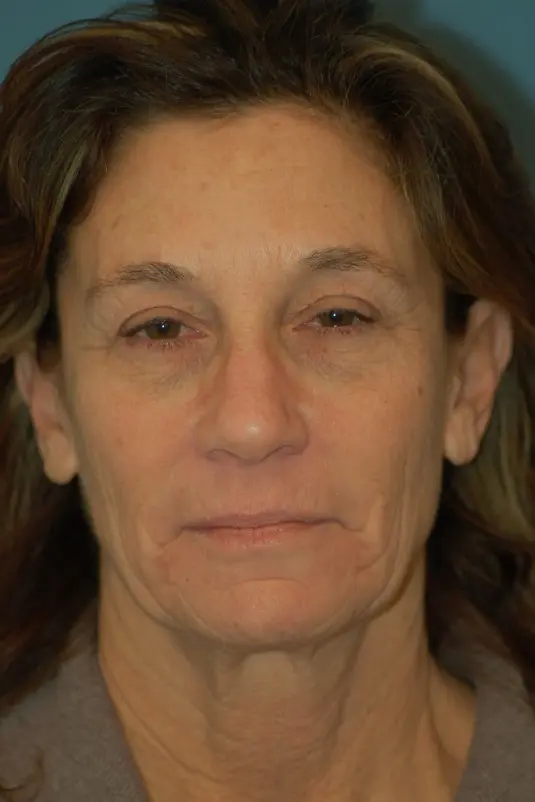 Upper lower eyelids-before