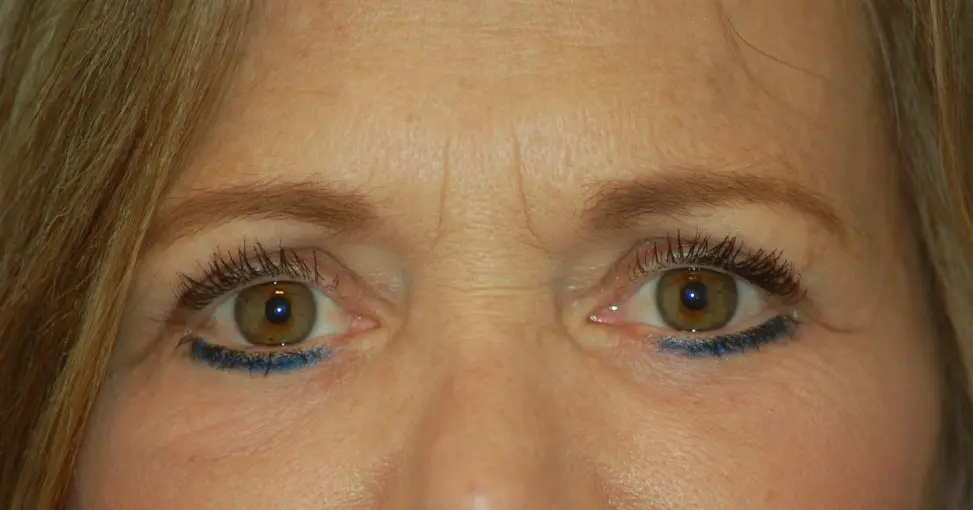 Lower eyelids and laser-after