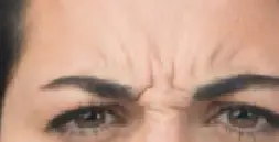 NEUROMODULATION BOTOX 2 before