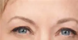 NEUROMODULATION BOTOX 1-after