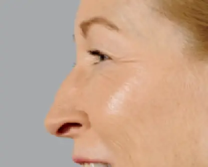 after-Voluma