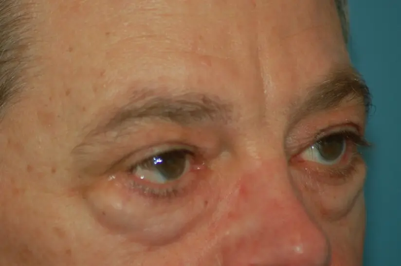 Lower eyelids before