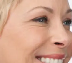 NEUROMODULATION BOTOX Right-after