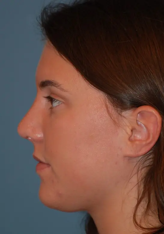 Open rhinoplastyafter