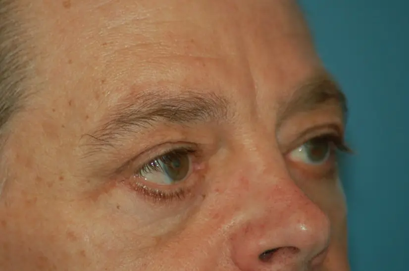 Lower eyelids after