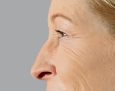 before-Voluma