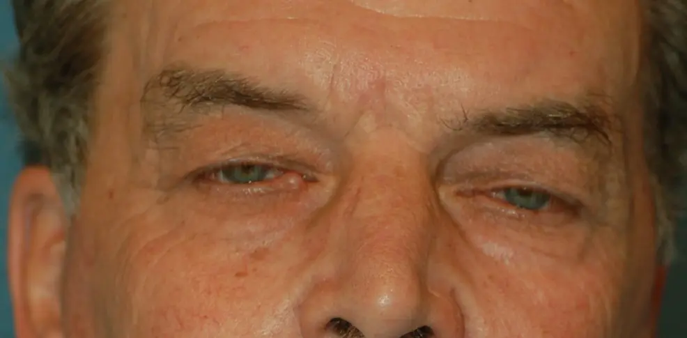 Upper eyelids-before
