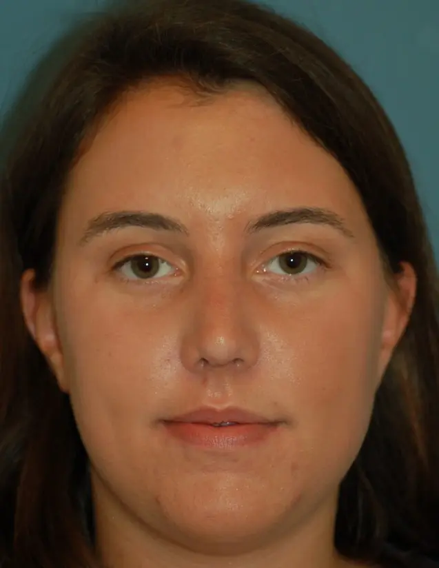 Open rhinoplasty -after