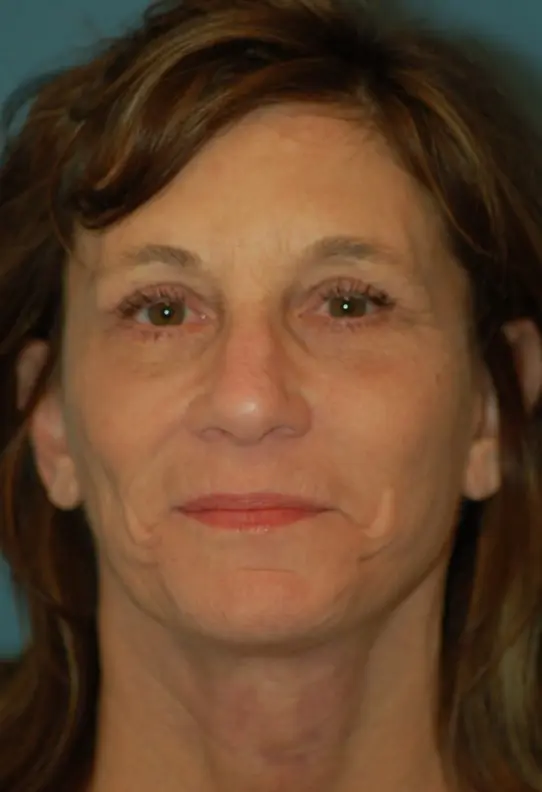 Upper lower eyelids - after