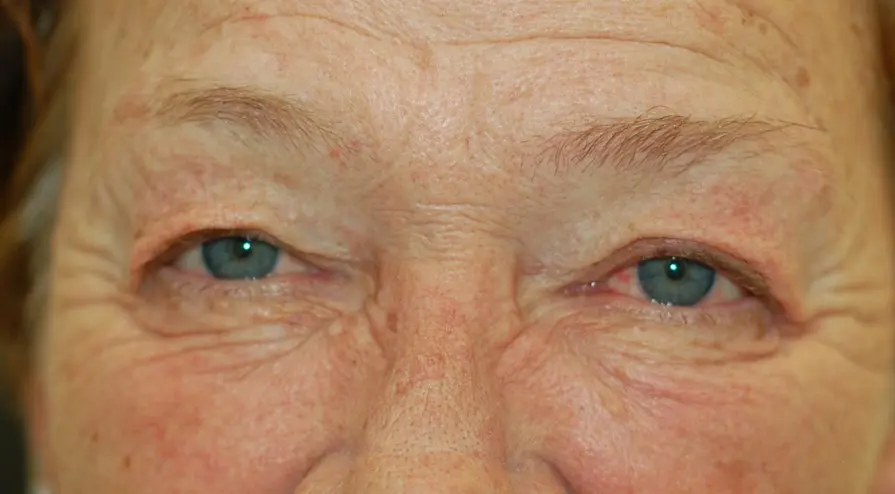 Upper lower eyelids and laser before