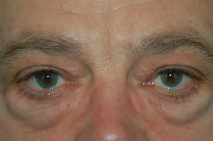 Lower eyelids-before