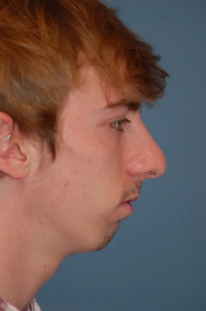 Open rhinoplasty- before